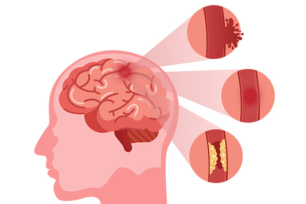 Recognise the Warning Signs of Stroke